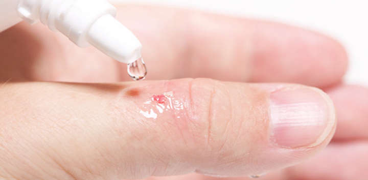 چسب قطره‌ای روی پوست چه‌طور پاک می‌شود؟